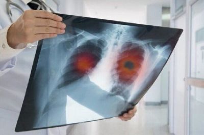Медики рассказали, кто больше всего подвержен раку легких