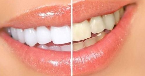 Чего не должно быть в продуктах для отбеливания зубов